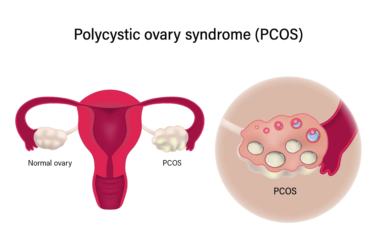 PCOS / PCOD Harmonal Therapy