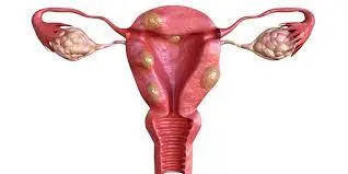 Uterine Fibroid Management