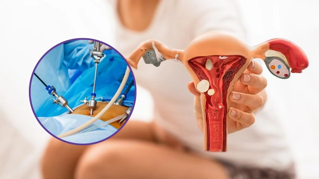 Endometriosis Treatment
