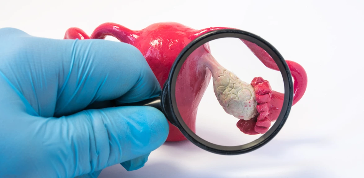 Ovarian Cyst Treatment