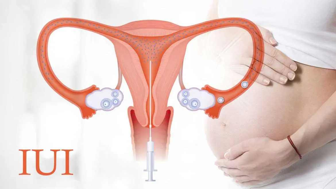 IUI (Intrauterine Insemination)