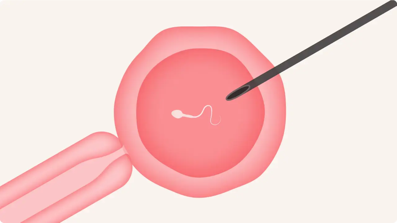 ICSI (Intracytoplasmic Sperm Injection)